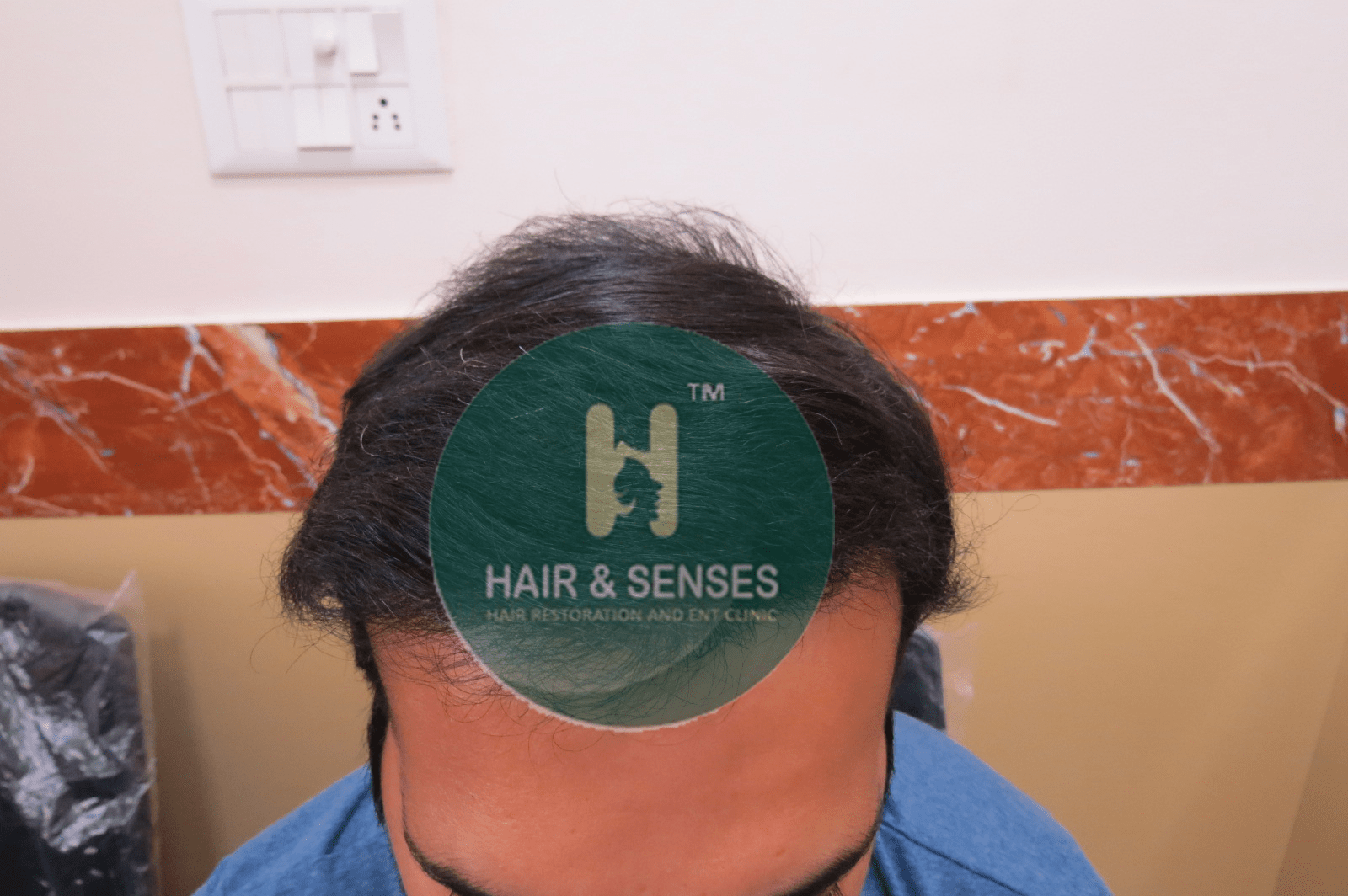 Hair Transplant Case Study